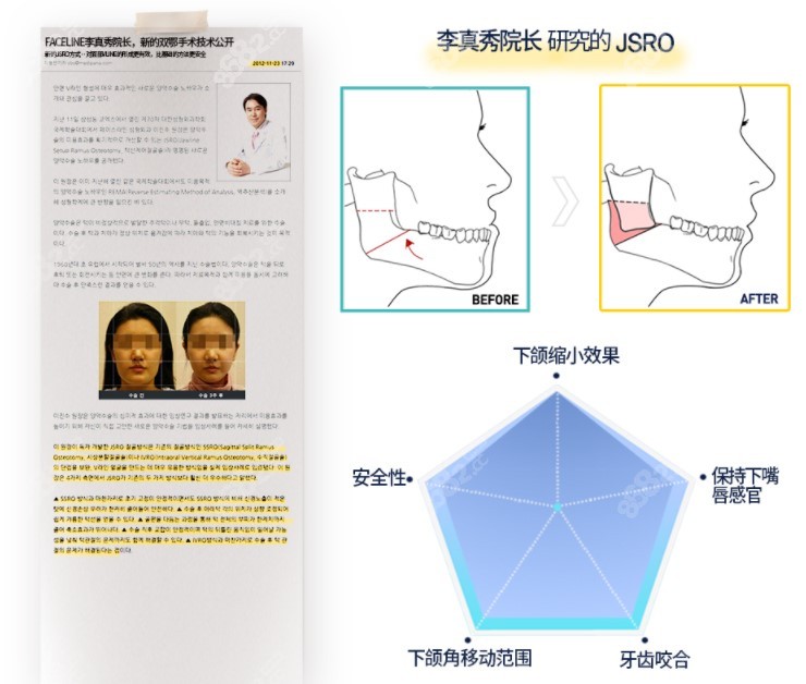 韩国菲斯莱茵整形医院双鄂手术技术优势