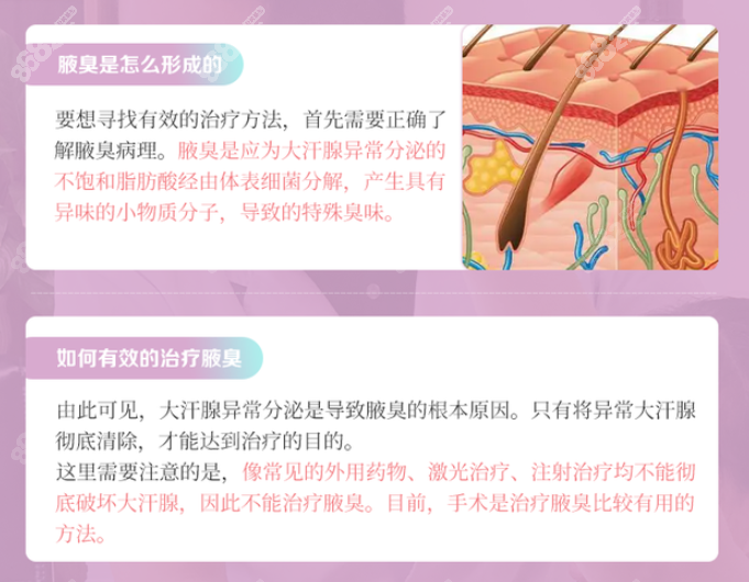 <!--<i data=20240705-sp></i>-->腋臭手术不会复发