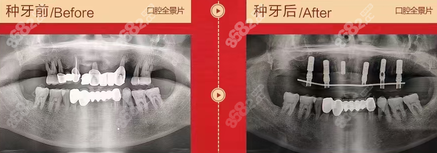 山东济宁壹颗牙口腔门诊部种植牙前后对比图8682.cc