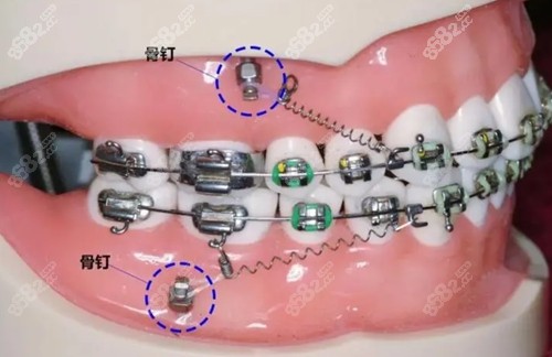 支抗钉辅助牙齿矫正