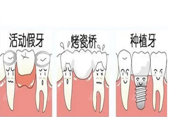 成都烤瓷牙