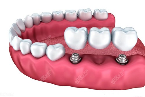 武汉爱尚大众口腔全口种植牙价格多少钱？