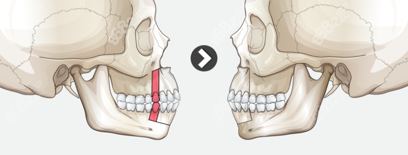 正颌手术改善凸嘴