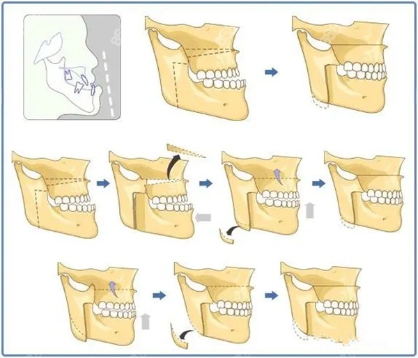 成都下颌正颌手术图示