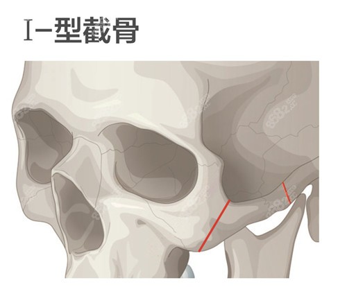 武汉吴中兴颧骨整形技术图解