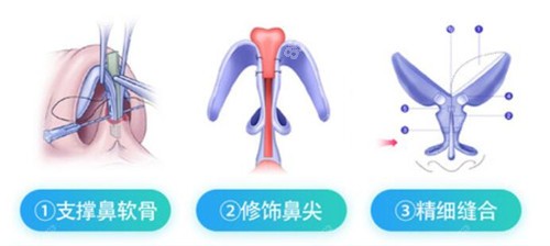 鼻综合示意图