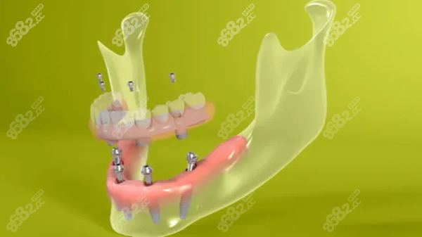 福州半口all on 4种植牙价格