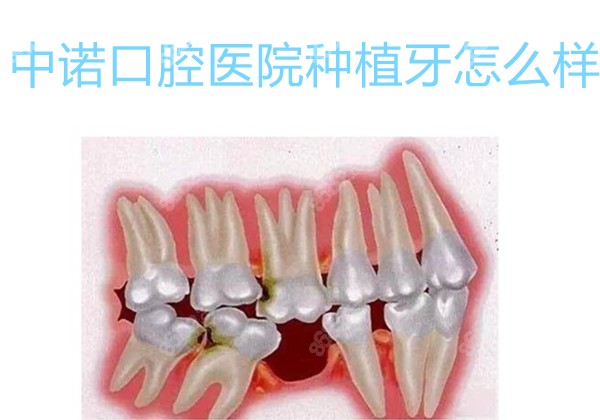 中诺口腔医院种植牙怎么样