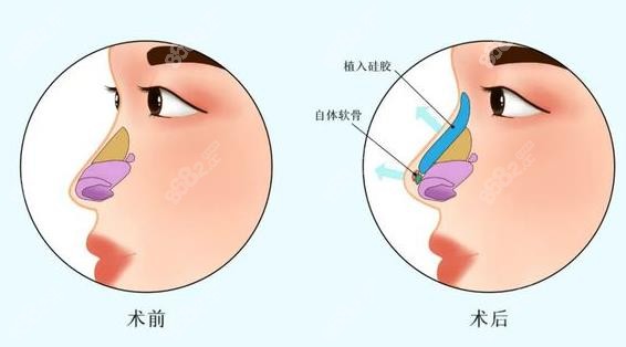 杨季涛医生做鼻整形前后对比图