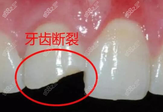 门牙折断怎么处理修复