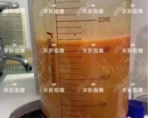 西安米兰柏羽宋新抽脂怎么样