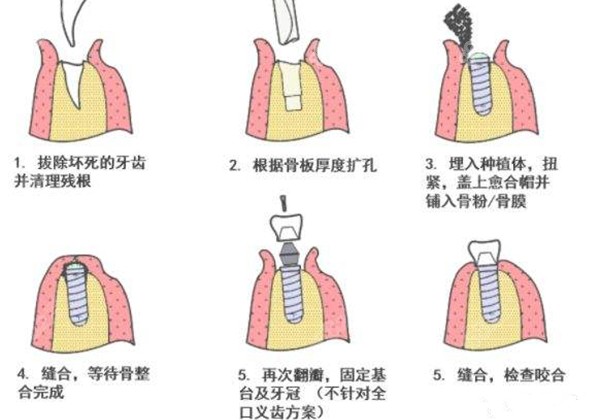 种植牙的植入过程