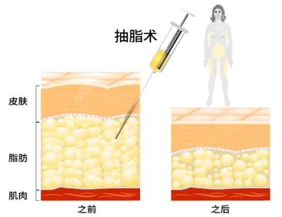 石家庄蓝山吸脂价格