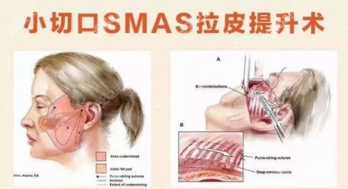 韩国tl医院小切口smas筋膜提升技术优势