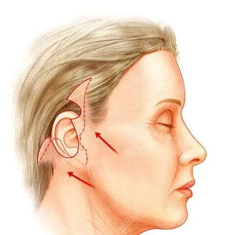 <!--<i data=20240705-sp></i>-->陈成拉皮手术切口示意图