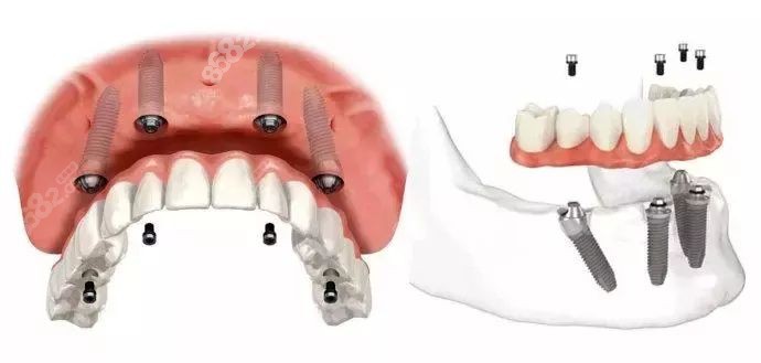 半口全口种植牙构成图
