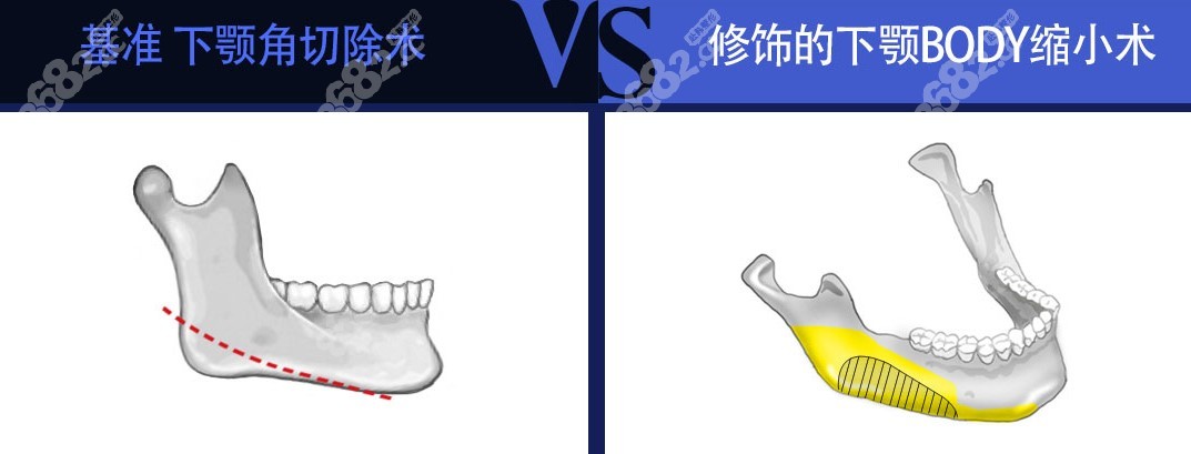 韩国菲斯莱茵下颌角切外板手术技术优势