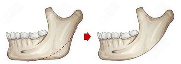西安下颌骨削骨大约多少钱