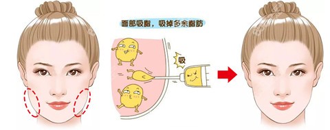 武汉张继强医生面部吸脂对比图