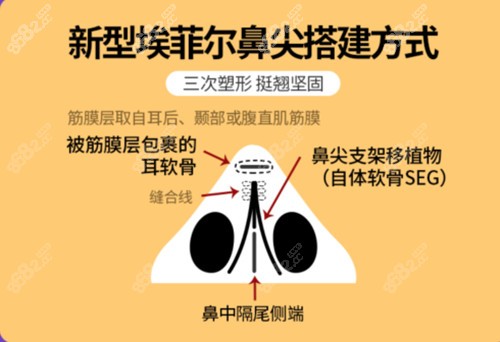 唐院长自创隆鼻技术二