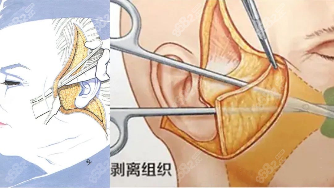 面部拉皮剥离步骤示意图