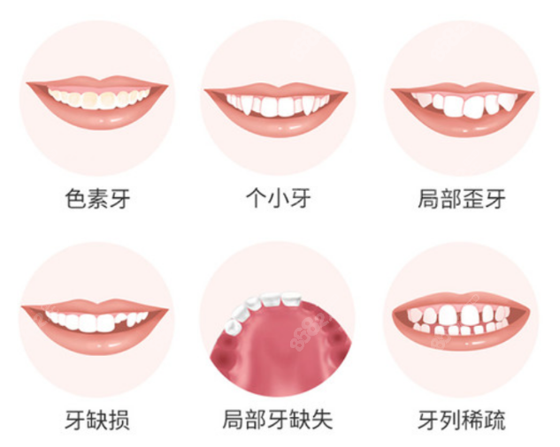 杭州做牙贴面好的医院有哪些