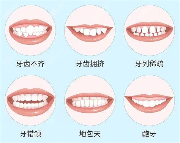 牙齿矫正适应症了解一下