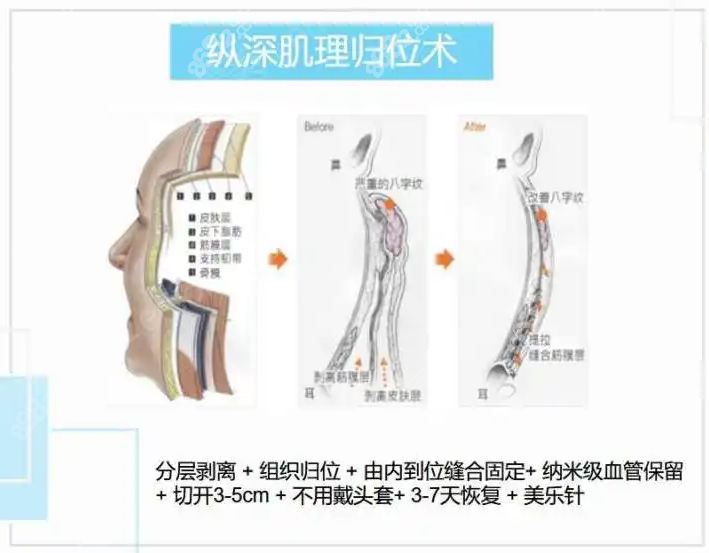 韩国清潭第1纵深肌理归位拉皮术