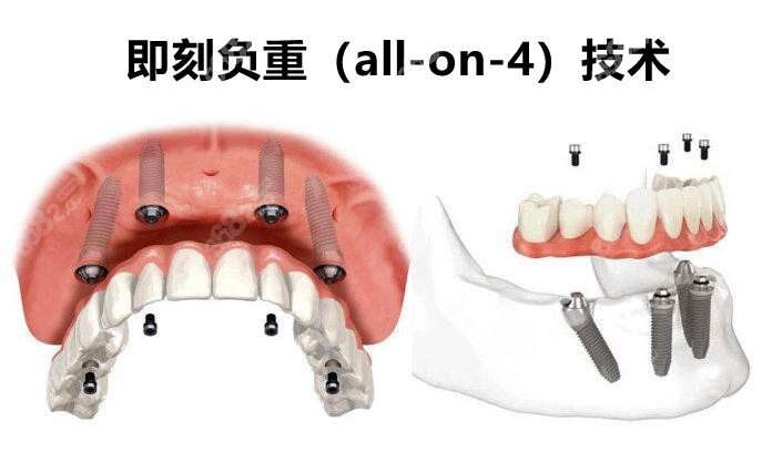 半口all-on-4种植牙价格：6万左右