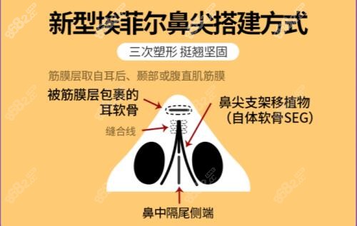 唐红伟埃菲尔黄金软骨鼻搭建方式