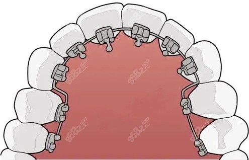 成人牙齿矫正器种类