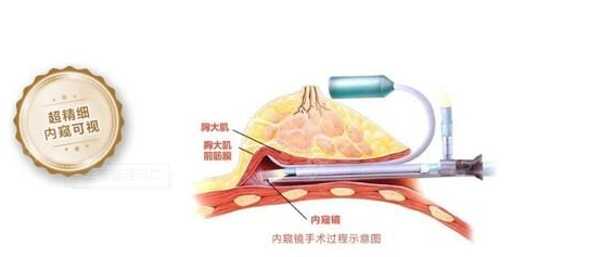 内窥镜隆胸技术