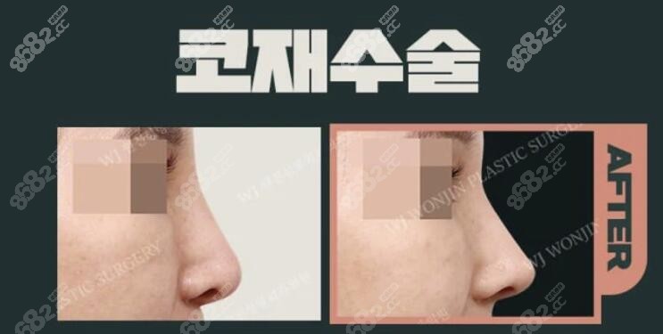 韩国原辰整形外科医院隆鼻手术对比照片
