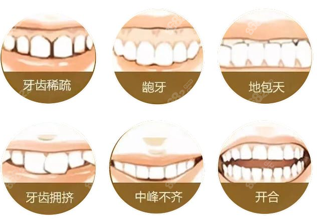 牙齿矫正适应症状