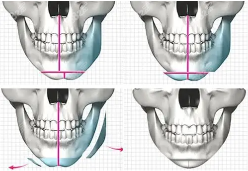 张笑天长曲线下颌角手术图示