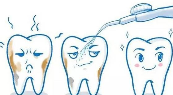 上海良宜口腔洗牙示意图