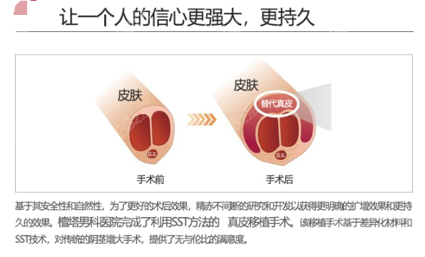 韩国世檀塔男科增粗手术做的怎么样？