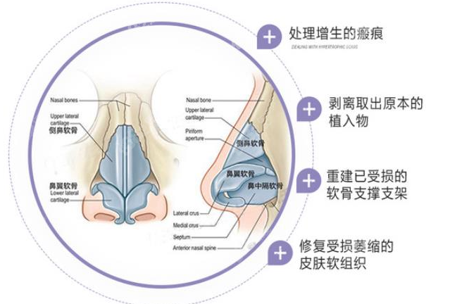 韩国will整形医院魏亨坤医生做鼻子好吗