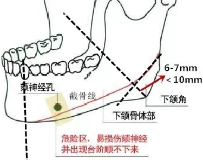 上海伊莱美李湘源下颌角截骨范围