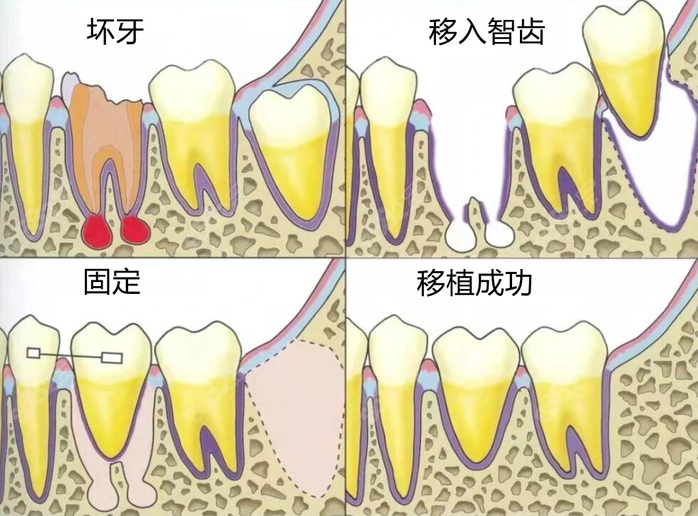 我做过自体牙移植图片