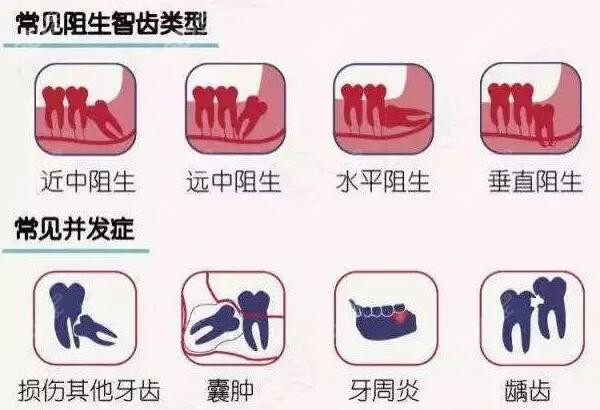 唐山拔阻生智齿多少钱一颗