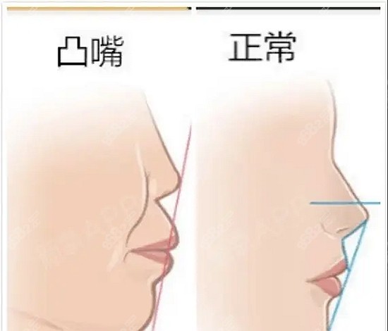 韩国做凸嘴手术多少钱