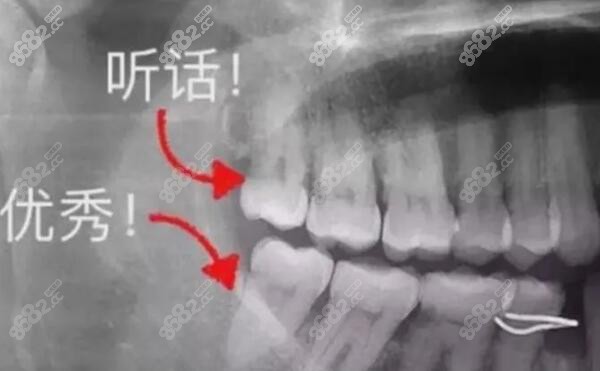 唐山拔智齿价格