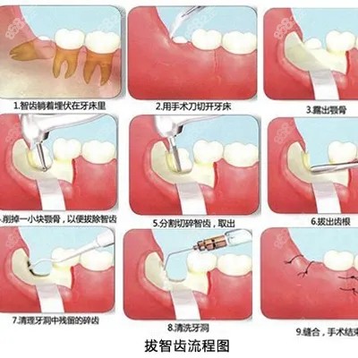 阳泉口腔医院拔出智齿的原理图