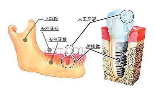 福州美可普种植牙怎么样