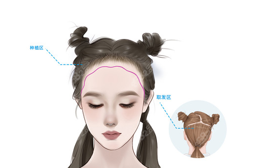 杭州首瑞不剃发的绒毛感发际线