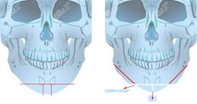 罗定安医生在下颌角整形方面的技术优势2