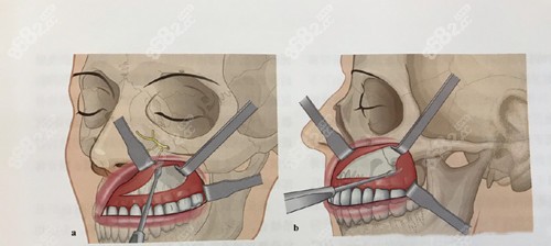 武汉改脸型好的医院颧骨内推技术图