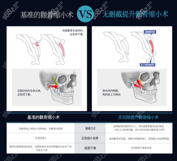 无删除颧骨缩小术