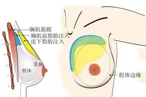 房志强棉花糖丰胸技术